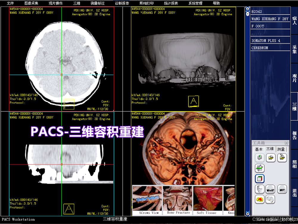 医院影像图像科室工作站PACS系统 DICOM 三维图像后处理与重建