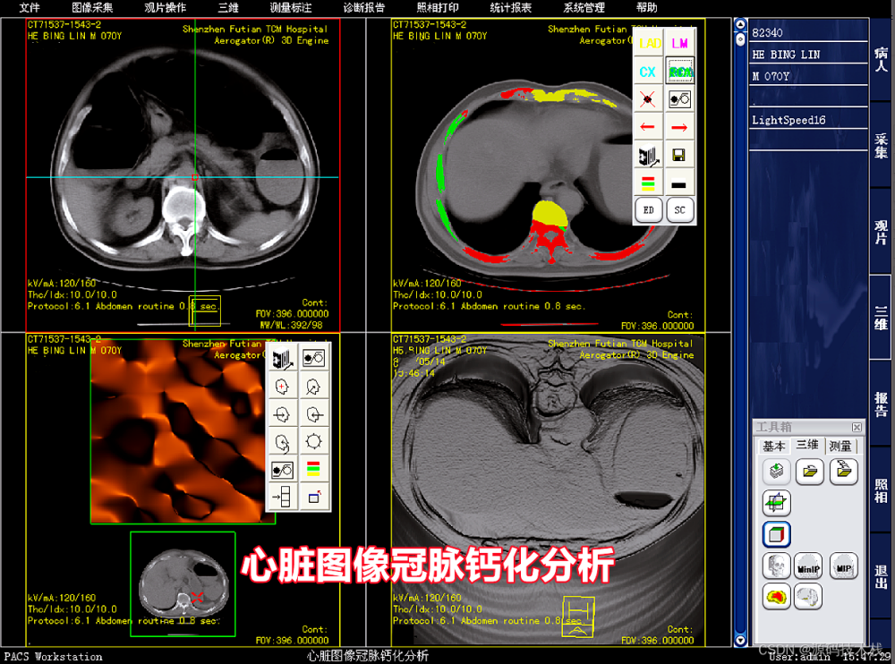 医院影像图像科室工作站PACS系统 DICOM 三维图像后处理与重建