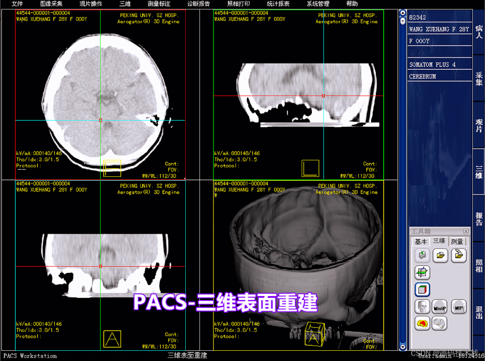 医院影像图像科室工作站PACS系统 DICOM 三维图像后处理与重建