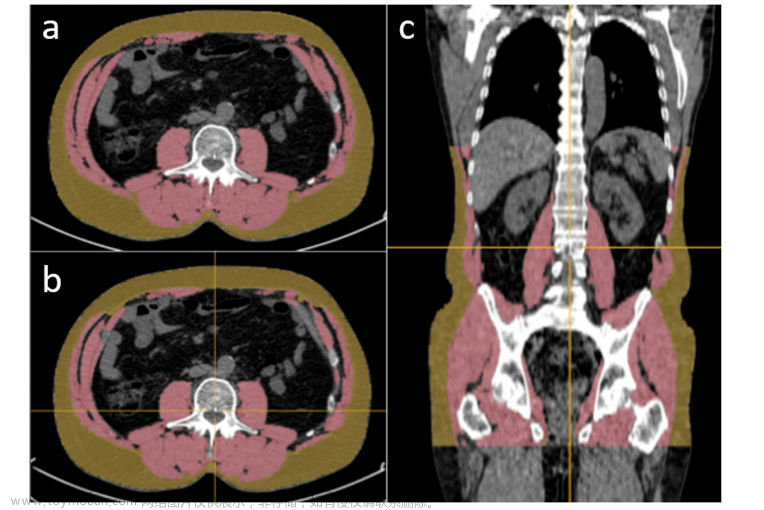 文献速递：人工智能医学影像分割---人工智能辅助的CT分割用于体成分分析：一项验证研究